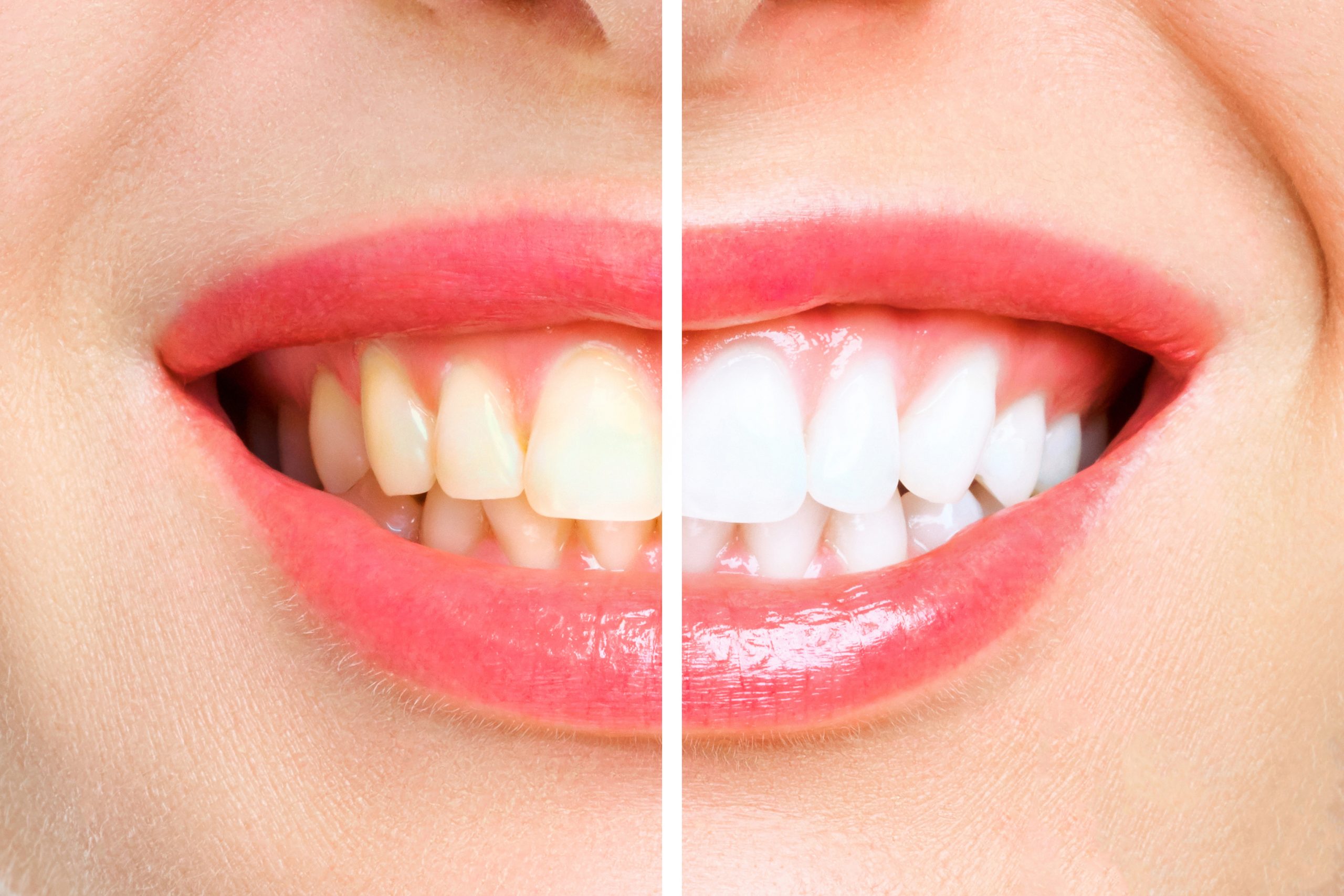 woman teeth before and after whitening.. Image symbolizes, stomatology
